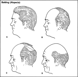 Balding (Alopecia)