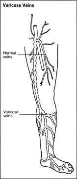 Varicose Veins