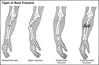 Type of Bone Fractures