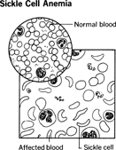 Sickle Cell Anemia