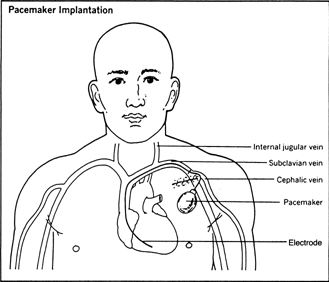 Pacemaker Implantation