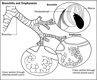 Bronchitis and Emphysema