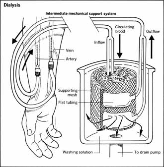 Dialysis