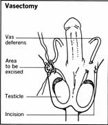 Vasectomy