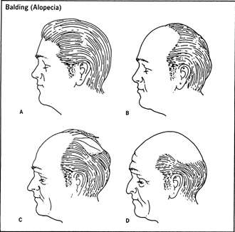 Balding (Alopecia)
