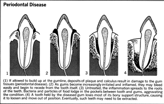 Periodontal Disease