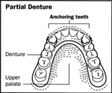 Partial Dentures