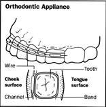 Orthodontic Appliance