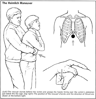 The Heimlich Maneuver