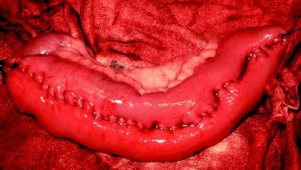 A section of large intestine inflamed by ulcerative colitis. (Reproduced by permission of Photo Researchers, Inc.)