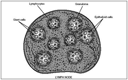 Lymph nodes are masses of lymphatic tissue that act as a filtering and cleansing system against disease-causing organisms. (Illustration by Electronic Illustrators Group.)