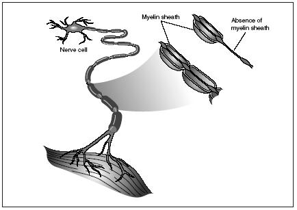 Multiple sclerosis is an immune cell attack on myelin, the insulation covering nerve fibers in the central nervous system. (Illustration by Electronic Illustrators Group.)