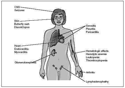 The autoimmune disease systemic lupus erythematosus can affect nearly every system in the body. (Illustration by Electronic Illustrators Group.)