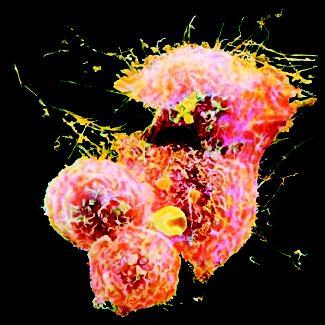 Hodgkin's lymphoma cells. This form of cancer begins in a lymph node—often in the neck—then progresses to other nodes. (Photograph by Andrejs Liepins. Reproduced by permission of Photo Researchers, Inc.)
