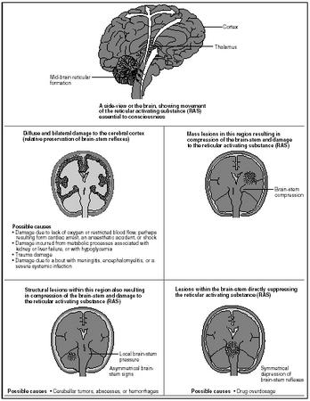 The brain conditions that result in coma. Coma is caused by interference with the cerebral cortex or the structures that make up the reticular activating system (such as the thalamus). (Illustration by Hans & Cassady.)