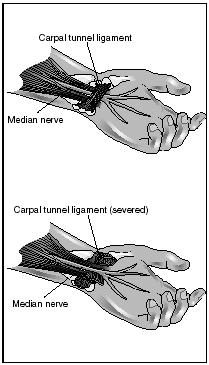 The most severe cases of carpel tunnel syndrome may require surgery to decrease pressure on the median nerve. (Illustration by Electronic Illustrators Group.)