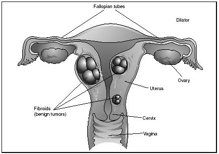 Locations of uterine fibroids. Also called myomas, uterine fibroids ...