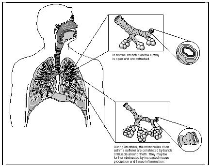 A comparison of normal bronchioles and those of an asthma sufferer. (Illustration by Hans & Cassady.)