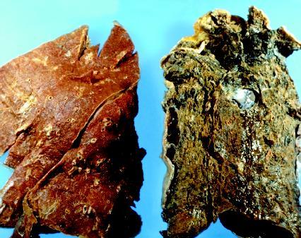 Healthy Lung Pictures