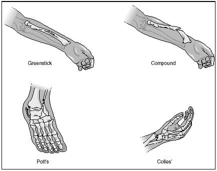 Common types of fractures and the sites where they occur. A fracture usually occurs when excessive force is applied in some manner to the bone. (Illustration by Electronic Illustrators Group.)