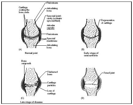 Three Diet Related Conditions Or Disorders Of The Skeletal System