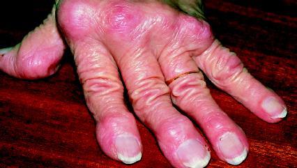 Rheumatoid arthritis is one of the most crippling forms of arthritis. It is characterized by chronic inflammation of the lining of joints. (Reproduced by permission of Science Photo Library/Photo Researchers, Inc.)