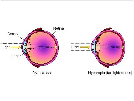 Farsightedness, known formally as hyperopia, is a condition of the eye where incoming rays of light reach the retina before they converge to form a focused image. (Illustration by Electronic Illustrators Group.)