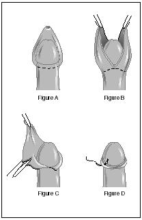 Drawing of the main steps involved in a circumcision. (Electronic Illustrators Group. Reproduced by permission of Gale Group.)