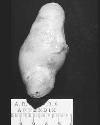 An inflammed appendix. (Photograph by Lester V. Bergman. Reproduced by permission of the Corbis Corporation [Bellevue].)