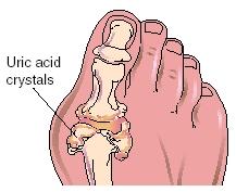 Uric acid crystals Gout is one form of arthritis caused by the buildup of uric acid crystals in a joint, most often the joint of the big toe. (Reproduced by permission of Electronic Illustrators Group)