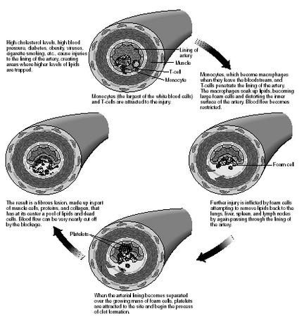 Flowchart illustrating the progression of atherosclerosis. (Illustration by Hans & Cassady)
