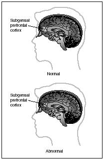 Recent scientific research indicates that the size of the subgenual prefrontal cortex (located behind the bridge of the nose) may be a determining factor in hereditary depressive disorders. (Reproduced by permission of Electronic Illustrators Group)