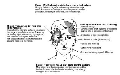 The phases of a typical migraine headache. (Illustration by Hans & Cassady, Inc.)