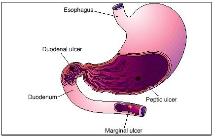 Illustration of the stomach with peptic ulcers. A peptic ulcer is one that occurs in the upper digestive tract. (Reproduced by permission of Electronic Illustrators, Inc.)