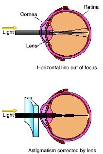 Astigmatism is a condition in which light from a single point fails to focus on a single point of the retina. The condition causes the patient to see a blurred image. (Reproduced by permission of Electronic Illustrators Group)