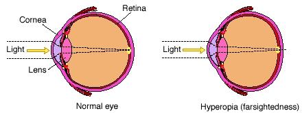 Hyperopia or farsightedness is a condition in which vision is better for distant objects than for close objects. (Reproduced by permission of Electronic Illustrators Group)