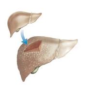 This illustration shows a healthy liver above, and a diseased liver below. Liver disease in alcoholics progresses from an enlargement of the liver to cirrhosis, which is characterized by liver scarring and is usually fatal unless alcohol consumption ceases. [Custom Medical Stock Photo, Inc. Reproduced by permission.]