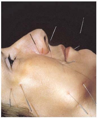 The rising popularity of alternative medicine has revived ancient techniques such as acupuncture. In the United States, the requirements for acupuncture licensure may vary from state to state. [Photograph by Yoav Levy. Phototake NYC. Reproduced by permission.]