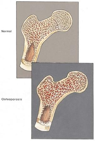 Calcium supplements can help prevent osteoporosis, which is a condition that occurs when bone breaks down more quickly than it is replaced. In this illustration, the bone above is normal, but the bone below is more porous and therefore more susceptible to fracture. [Custom Medical Stock Photo, Inc. Reproduced by permission.]