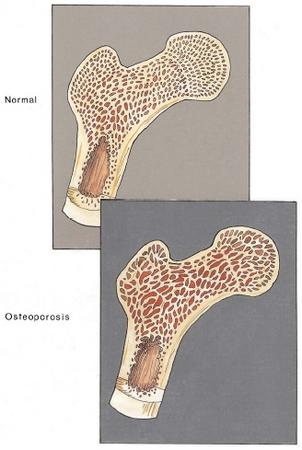 deficiency of calcium. Calcium supplements