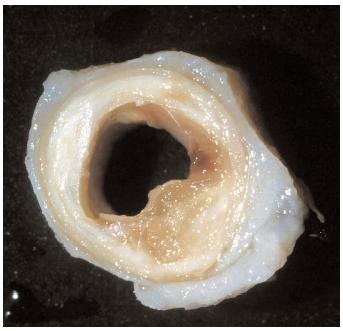 This cross section of a coronary artery shows plaque buildup, possibly indicating coronary artery disease—the most common cause of death worldwide. Risk factors for the disease include poor diet, cigarette smoking, and stress, among others. [B&B Photos/Custom Medical Stock Photo. Reproduced by permission.]