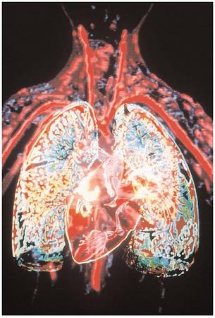 This scan of the cardiovascular system shows the heart and lungs, with major blood vessels radiating from them. Cardiovascular diseases, which affect the pumping of the heart and the circulation of blood, are the leading cause of death in developed nations. [Photograph by Howard Sochurek. Corbis. Reproduced by permission.]