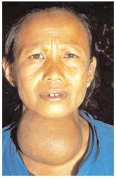 An example of grade III (large and visible) goiter. Most cases of goiter in the developing world are due to an iodine deficiency. Unable to meet the body's hormonal needs, the thyroid becomes enlarged to compensate. [© Lester V. Bergman/Corbis. Reproduced by permission.]