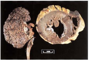 A kidney (left) and a cross-section of a heart (right) that were affected by hypertension. The heart shows signs of advanced atherosclerosis, one possible complication arising from hypertension. [Photograph by Dr. E. Walker. Photo Researchers, Inc. Reproduced by permission.]