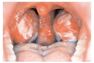 Glandular fever, or mononucleosis, is a viral infection that causes inflamed tonsils (shown here) and fever, and may cause an enlarged spleen. Symptoms most often appear in teens, but more than 80 percent of adults in the United States carry the virus and can transmit it. [Science Photo Library/Photo Researchers, Inc. Reproduced by permission.]
