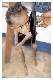 An acutely malnourished Liberian boy is weighed at a therapeutic feeding center. Such centers, operated by international relief organizations, provide intensive care and a specialized diet to rehabilitate severely malnourished children. [AP/Wide World Photos. Reproduced by permission.]