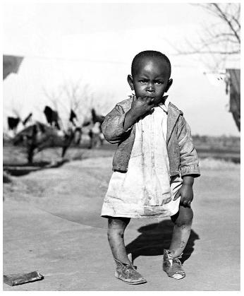 This child's bowed legs are a symptom of rickets, a disease resulting from vitamin-D deficiency. Because their skin absorbs less sunlight, dark-skinned people need more sun exposure to synthesize the recommended daily amount of vitamin-D. [photograph by Marion Post Wolcott. Corbis. Reproduced by permission.]