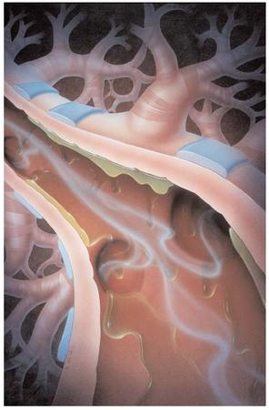 An illustration of cigarette smoke entering the lungs. Cigarette smoke contains over 4,000 chemicals, many of which are toxic or carcinogenic. Repeated inhalation of the smoke causes permanent damage to internal organs and reduces the body's ability to fight infection. [Todd Buck/Custom Medical Stock Photo, Inc. Reproduced by permission.]