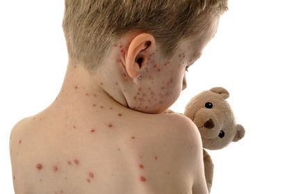 Chickenpox 2646