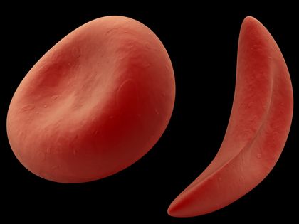 Sickle Cell Anemia Description 2750